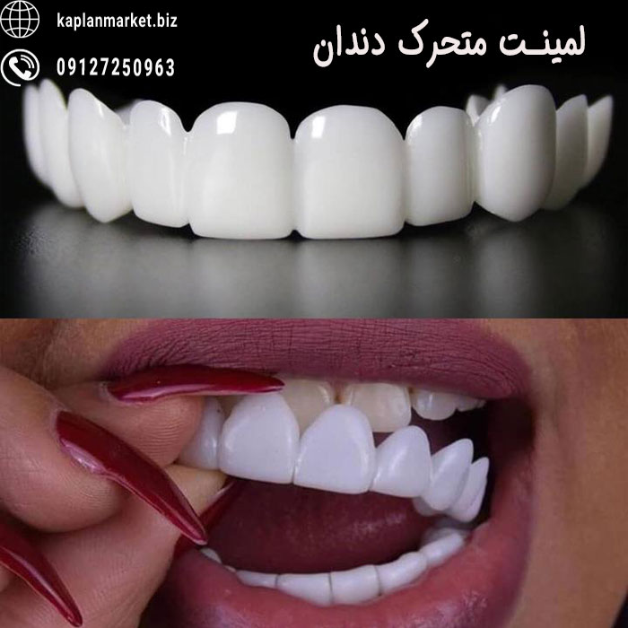 خرید ارازن بهترین مدل لمینت متحرک دندان 
