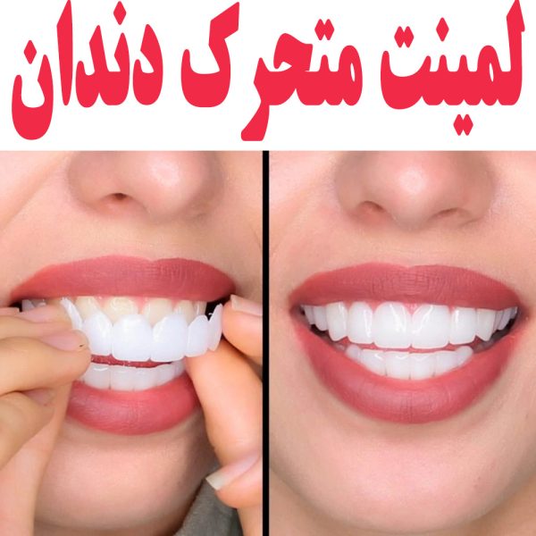 لمینت متحرک دندان اورجینال ترو اسمایل و اسنپ آن اسمایل